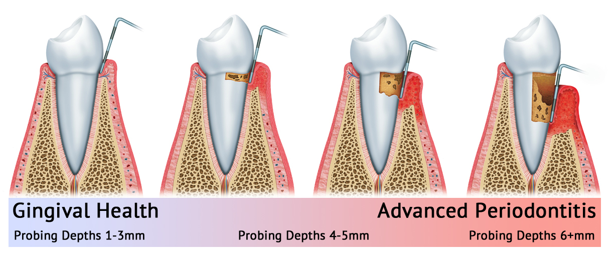 Stages of Periodontal Disease 1218x519
